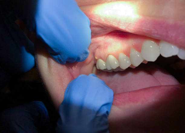 Best Cracked Tooth Emergency Dentist  in Galesville, WI